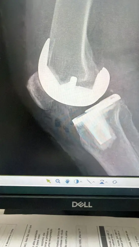 Radiografia de perfil de prótese do joelho